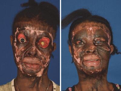 Liberia: Acid attack due to refusal of marriage.