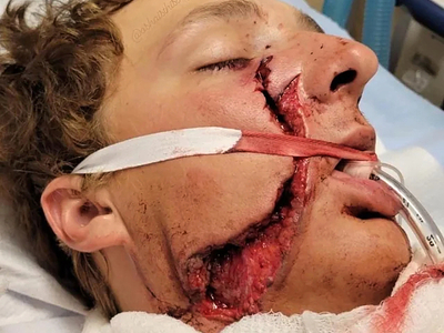 He survived a serious facial injury from a circular saw