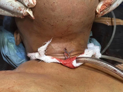 Removal of a mandibulectomy mass