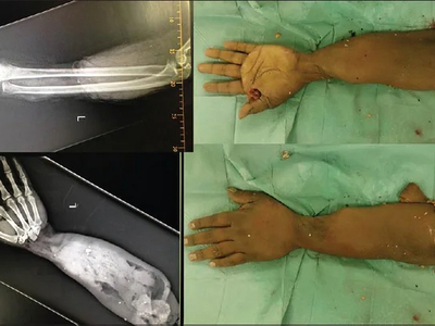 Avulsion amputation of left forearm