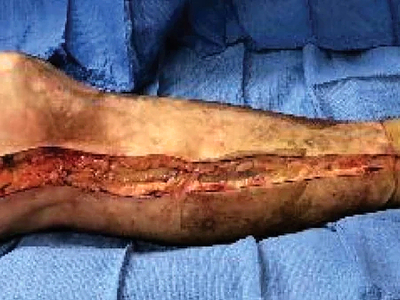 Escharotomy pictures after severe burns