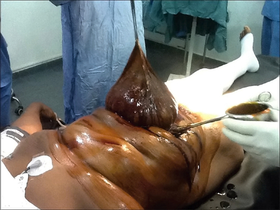 Giant pedunculated incisional hernia