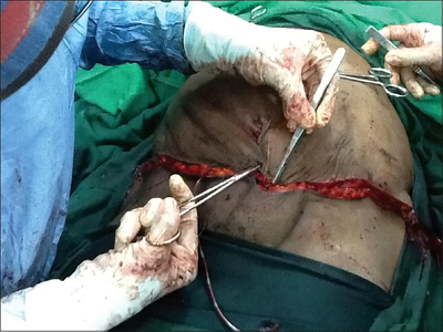 Giant pedunculated incisional hernia
