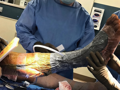 Necrotizing fasciitis of the leg