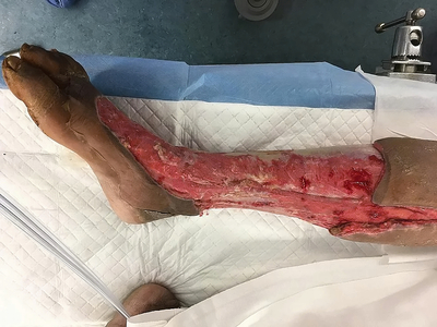 Necrotizing fasciitis of the leg