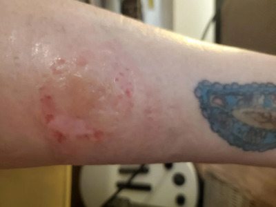 HotHands Burn-Day 1 to Week 5