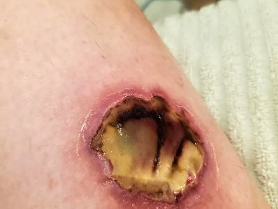 HotHands Burn-Day 1 to Week 5