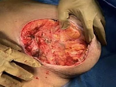Necrotizing fasciitis of the breast