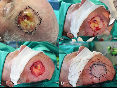 Locally advanced squamous cell carcinomas
