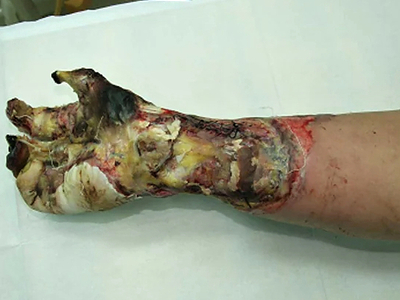 High Voltage electrical burns