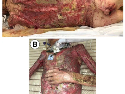 68-year-old male burned over 46% total body surface area