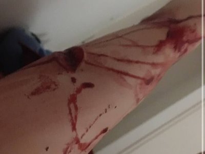 depressed teenager bloody self harm 