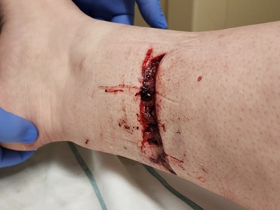 Dog bite wound