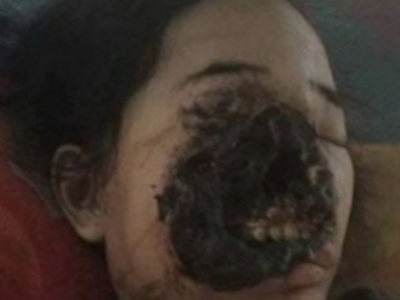Young Indian Woman  Suffering From The 'black fungus' 
