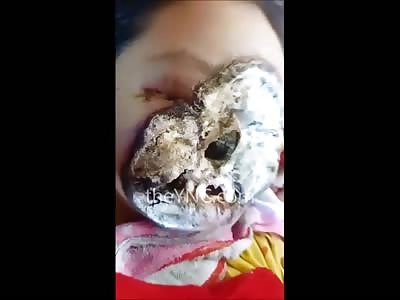 Sad Sad Video of Young Girl with Disease of Necrosis of the Face
