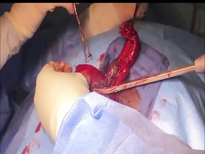 Intestine slid out of ass required surgery