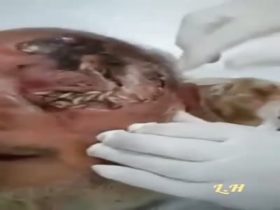 Old man with rotting skull receives maggot treatment.