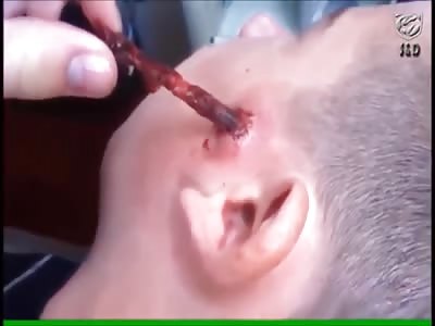 Kid Has The Weirdest/Grossest Thing Pulled From His Face