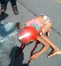 Girl Still Agonizes With Femur Exposed After Strong Head On Collision Against Bus