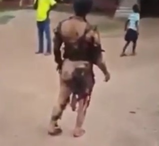 Sad Video Shows Woman and Her son Walking Around With Body Totally Burned