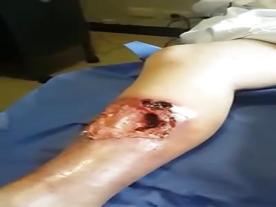 Disgusting Footage of Maggot Riddled leg in the Hospital 