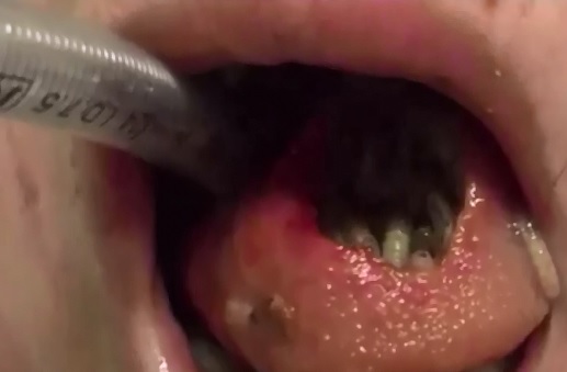 Short yet Disgusting Video of a Boy with Maggot Mouth 