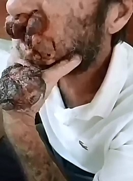 Poor man has Horribly Disfigured Hand and Face