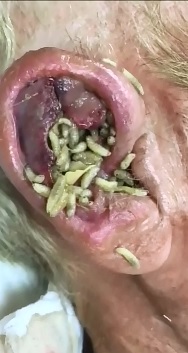 Disgusting..Ear Full of Maggots in Elderly Woman 