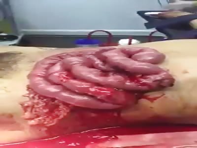 Just a Weird Video of Intestines Moving outside of Body 