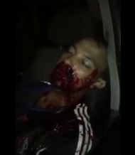 Thug Shot Gurgles Blood From Nose and Mouth