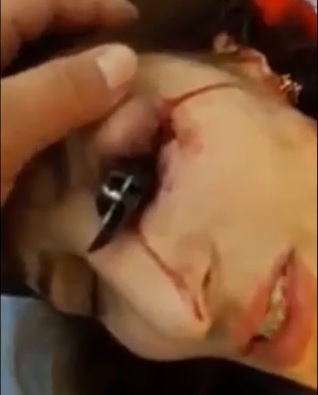 Woman Arrives in ER With Knife Stuck in Her Eye