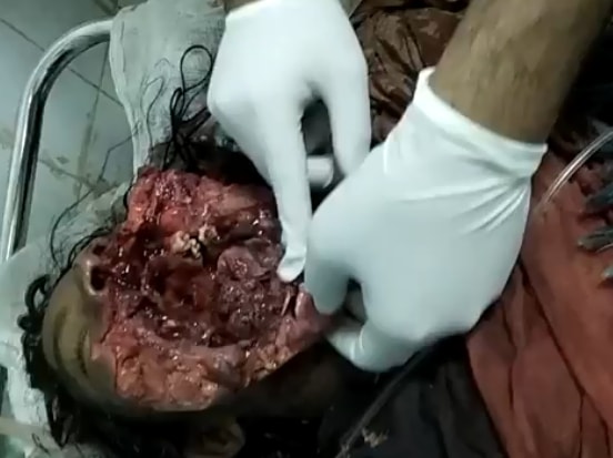 Guy's Face Exploded and Doctors Figuring out How to Fix it