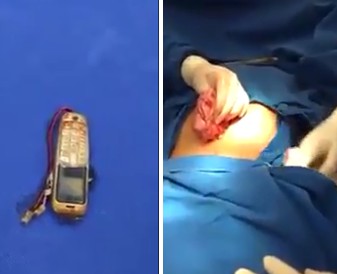 Inmate having a cellphone removed from his stomach