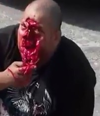 Man With Disfigured Face After Accident (Great Quality)
