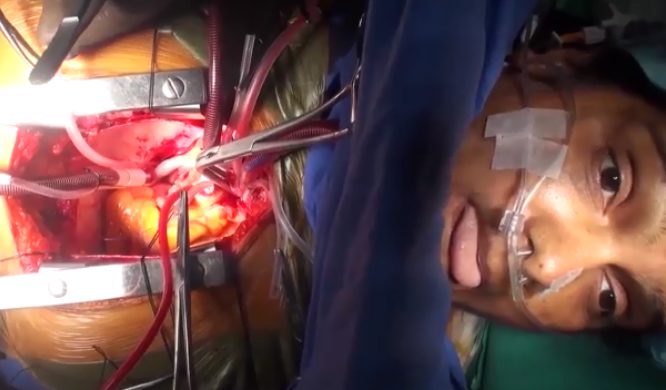 Man wakes up during open heart surgery