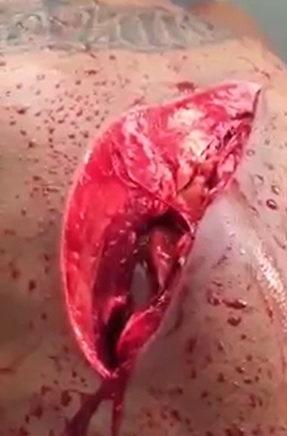 Mans Chest Split Open and His Heart Beating Through the Chest Cavity . (machete attack) 