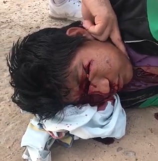 Dude Sliced Across his Face with Machete 