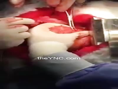 (New) Removing A Bullet From A Beating Heart
