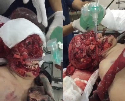 Horrible: After Acid Attack This Woman Lost Her Face!