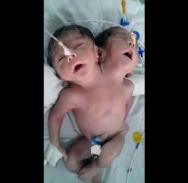 Rare Condition: Baby Was Born with Two 2 Heads in Vietnam