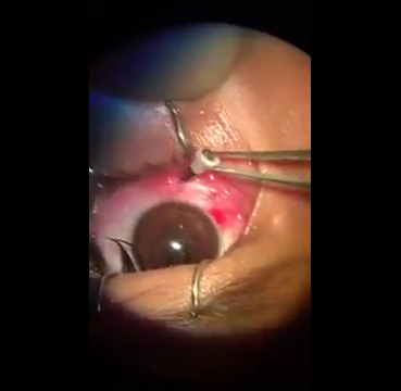 See the Removal of The Tip of a Pencil Skewered in one Eye