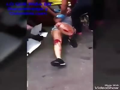 POOR GIRL LAYS ON STREET LEG BROKEN FROM ACCIDENT