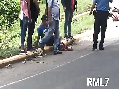 MAN'S SHATTERED LEG AFTER AN ACCIDENT (video doesn't work)