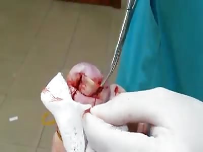 Painful nail buried