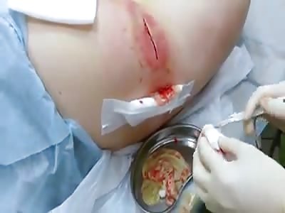 Abscess - Incision and Purulent Drainage HD