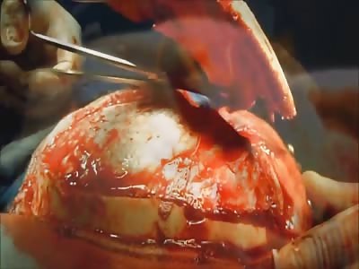 Neurosurgery - brain clot removal  HD