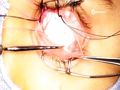 Ocular surgery