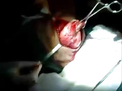 Extraction of maxillary tumor