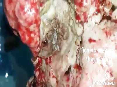 Cancer in the mouth infected with worms