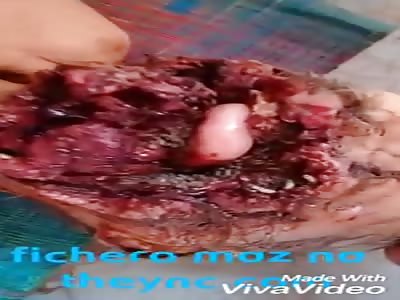 Severe cancer in the mouth infected with worms